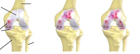 degré d'arthrose