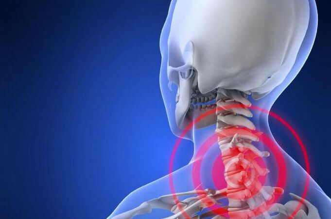 La douleur fulgurante dans le cou est un symptôme précoce de l'ostéochondrose cervicale
